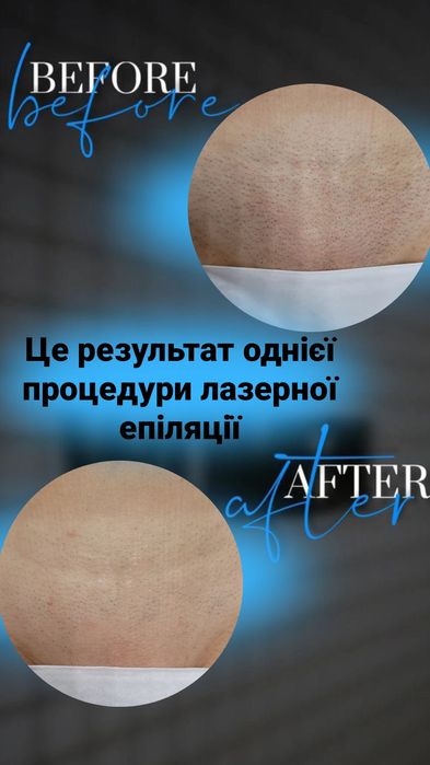 Епіляція на діодному лазері,лазерна епіляція.