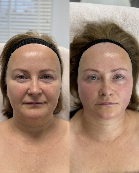 Міофасціальний масаж обличчя