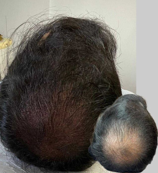 Micropigmentação capilar.