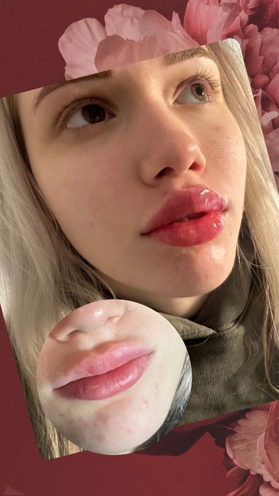 Увелечения Губ Контурная пластика