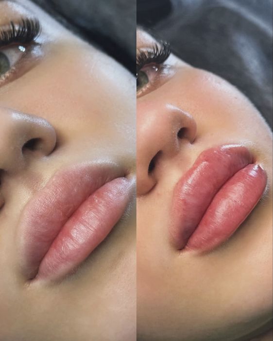 Контурна пластика губ, Біоревіталізація Акція!!!