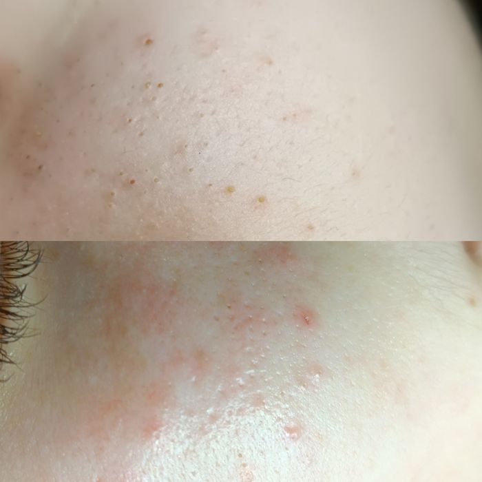 Косметолог Чистка лица Пилинг Rf лифтинг