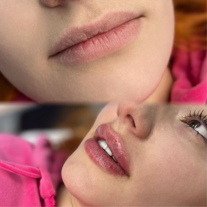 Косметолог|Ботокс|Контурна пластика губ.Центр міста