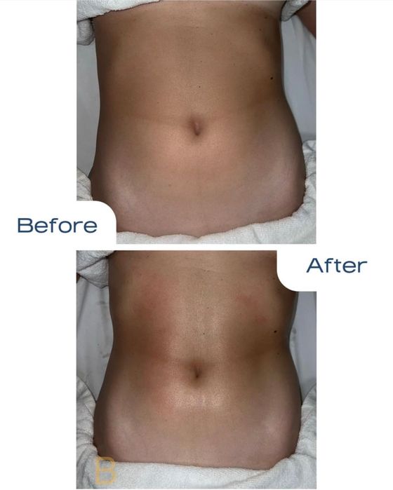 Drenagem linfática método Renata França