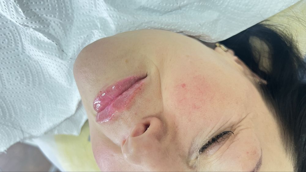 Увеличение губ , ботулинотерапия, контурная пластика