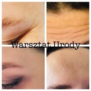 300zł= Kwas Hialuronowy Powiększenie Ust / Wolumetria 250z/ BOTOKS 200