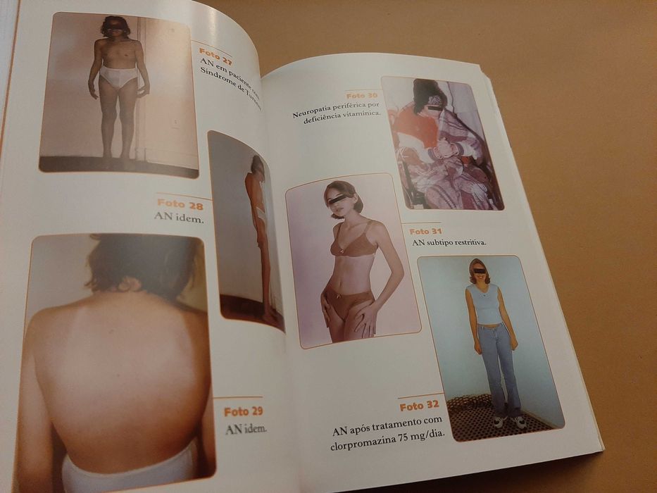 Anorexia, Bulimia e Obesidade// Salvador de Rosis Busse