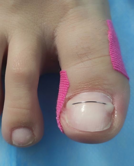 Подолог. Послуги подолога, медичний педикюр,  естетичний педикюр