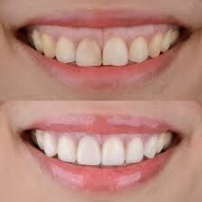 Ботокс| Все зоны | Одесса| Цент