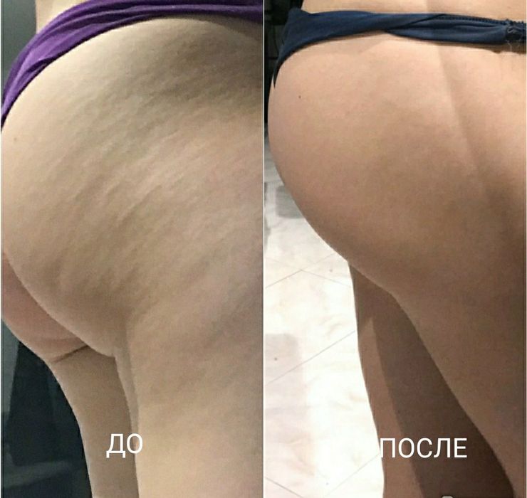 Массаж Антицеллюлитный, Классический, Лимфодренажный