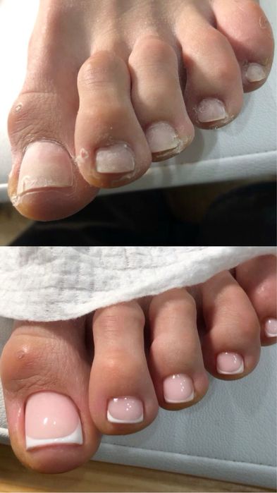 Педикюр Николаев.Чистые пятки без лезвия.600 грн.Стерильно