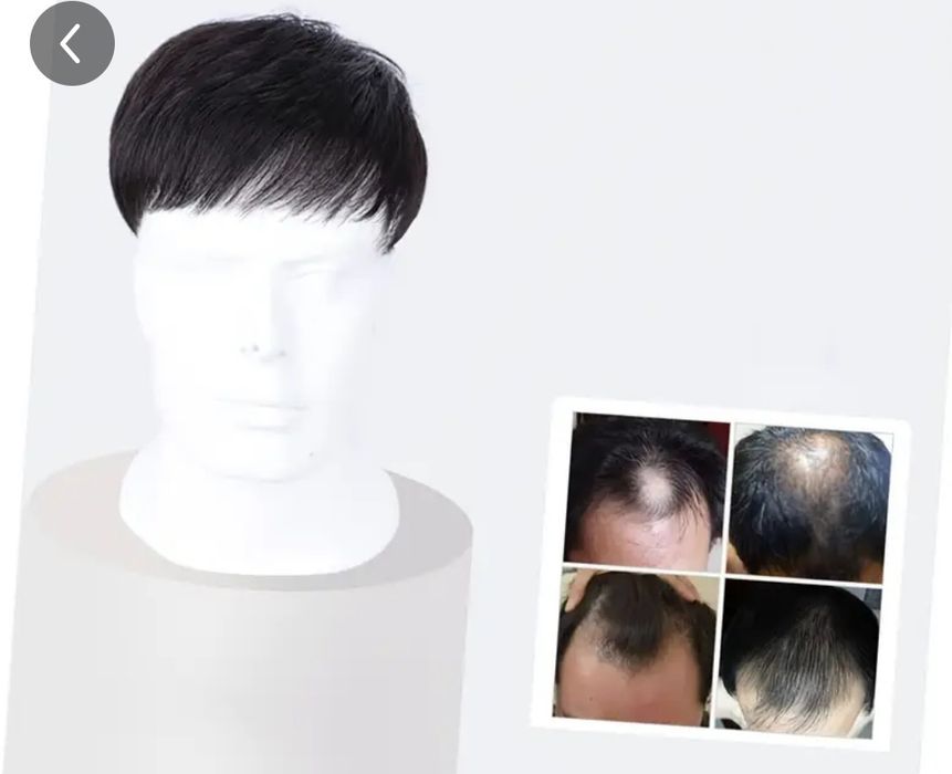 Prótese capilar com clips