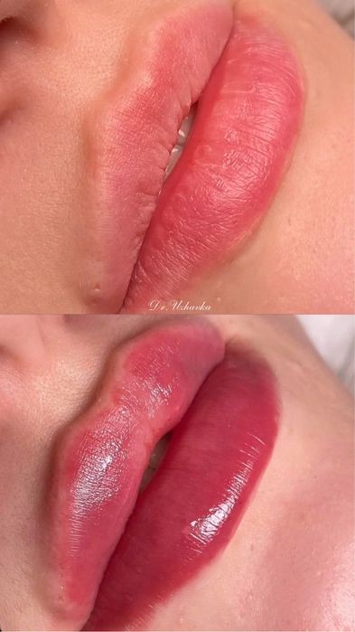 Ботокс чоло-1900 грн!Біоревіталізація, збільшення губ Одеса, центр