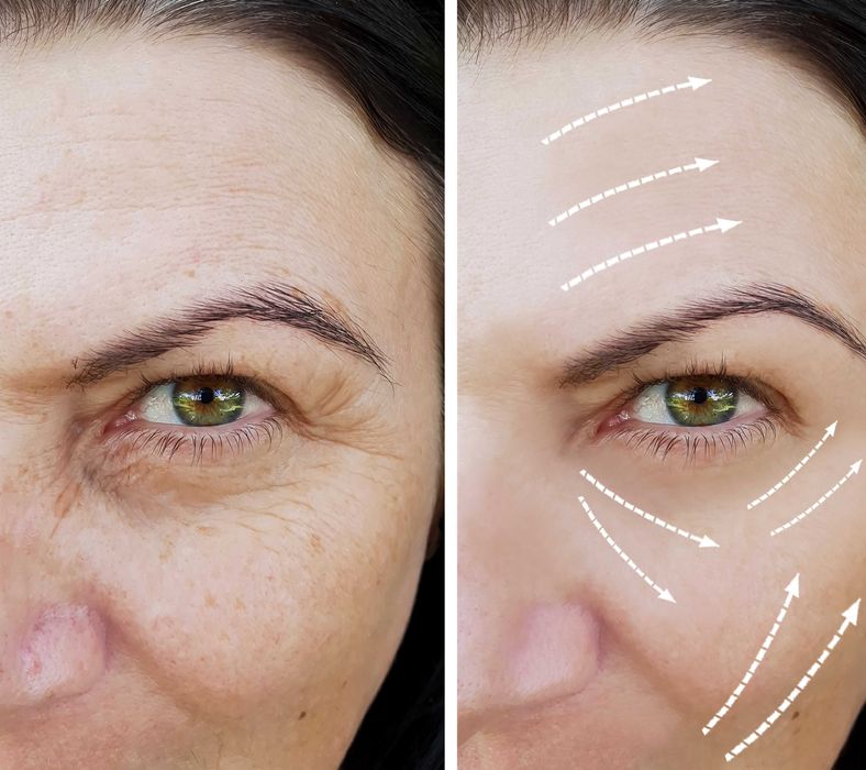 Аппарат HIFU для SMAS-лифтинга Lift Pro body hifu, 5 катріджів