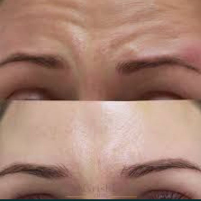 Губки ботокс гусинные лапки