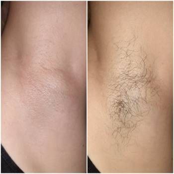 Шугаринг на дому