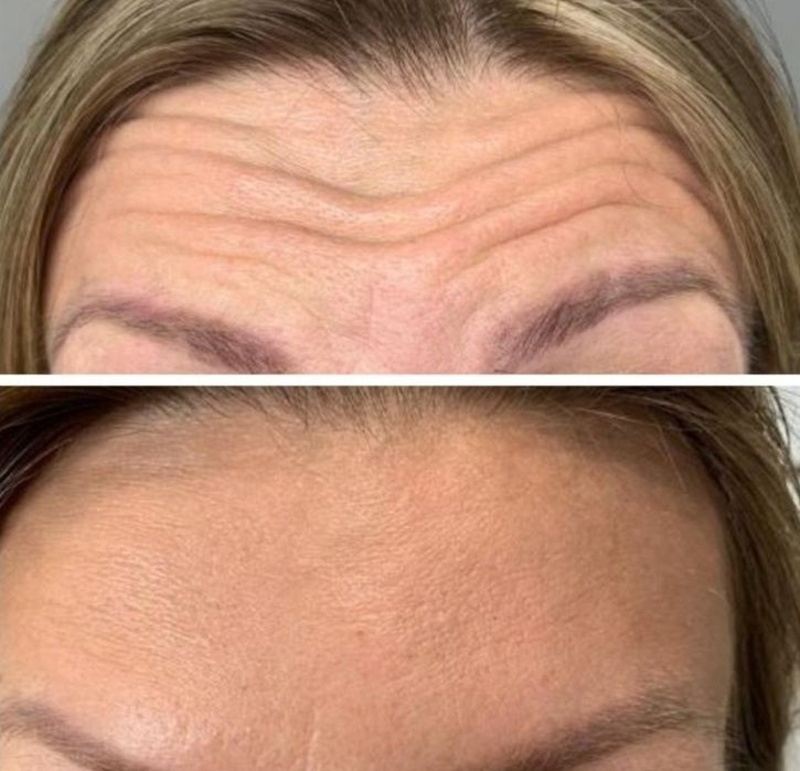Promocja! Botox promocja 1 okolice 130zł do końca sierpnia