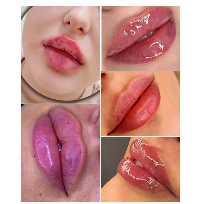 1500 грн губи контурна пластика.Ботокс.