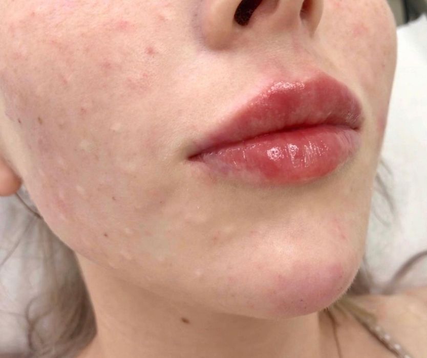 Косметолог.Увеличение губ.Мезотерапия Биоревитализация,Плазмолифтинг,