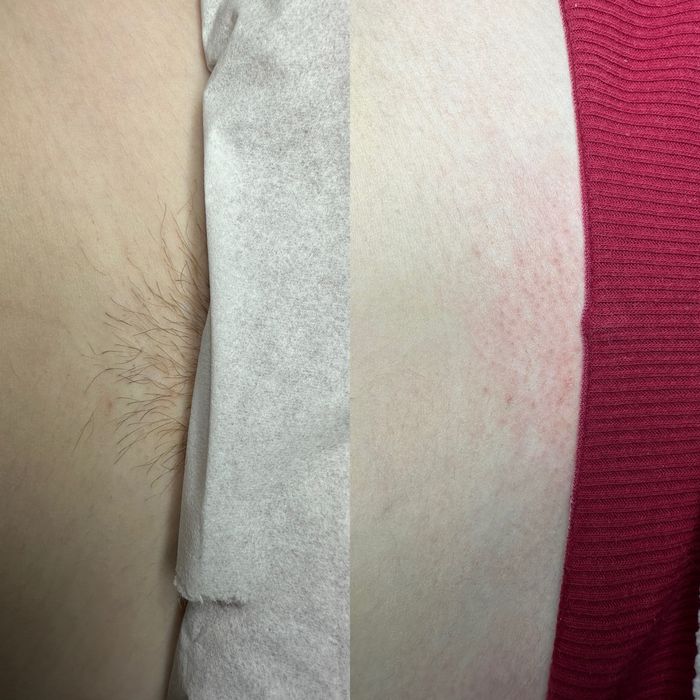 Навчання курси електроепіляції Біла Церква