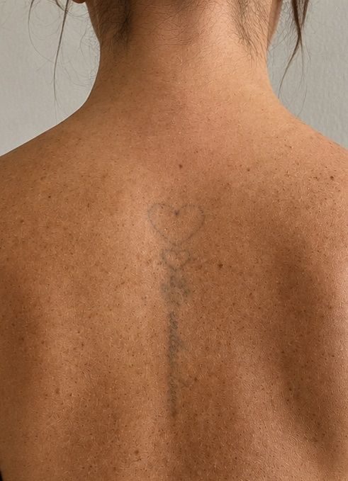 Modelos - Remoção de Tatuagem a Laser e Peeling de Hollywood
