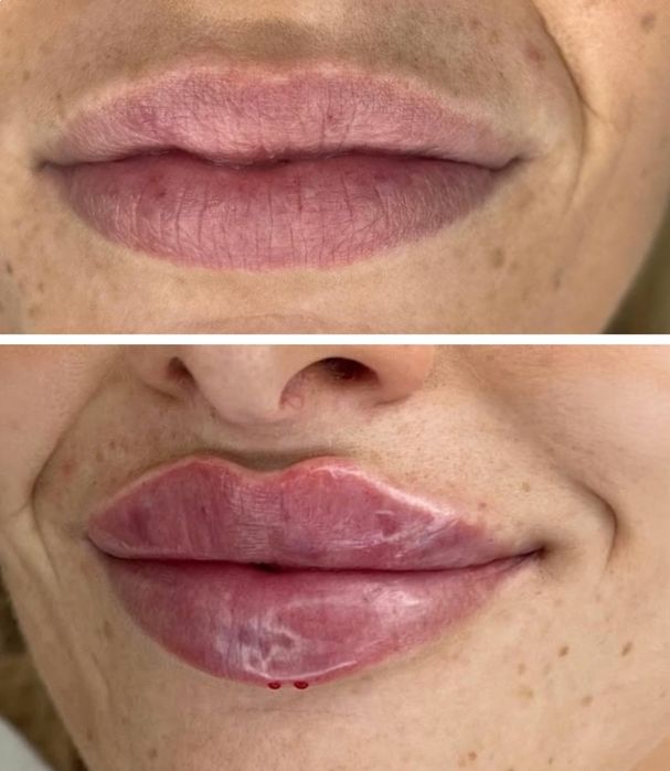 PROMOCJA powiększania ust 380zł , btx , Stymulatory