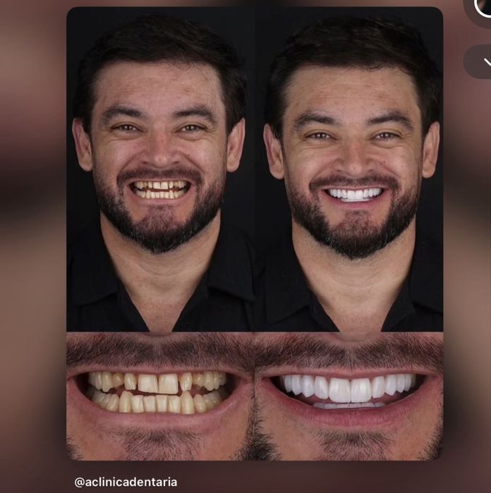 20 Facetas em Resina — Oferta Especial | Sorriso Renovado
