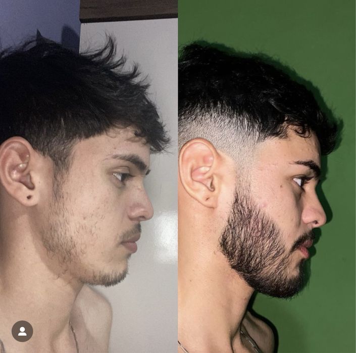Minoxidil foligain extra forte + dermaroller