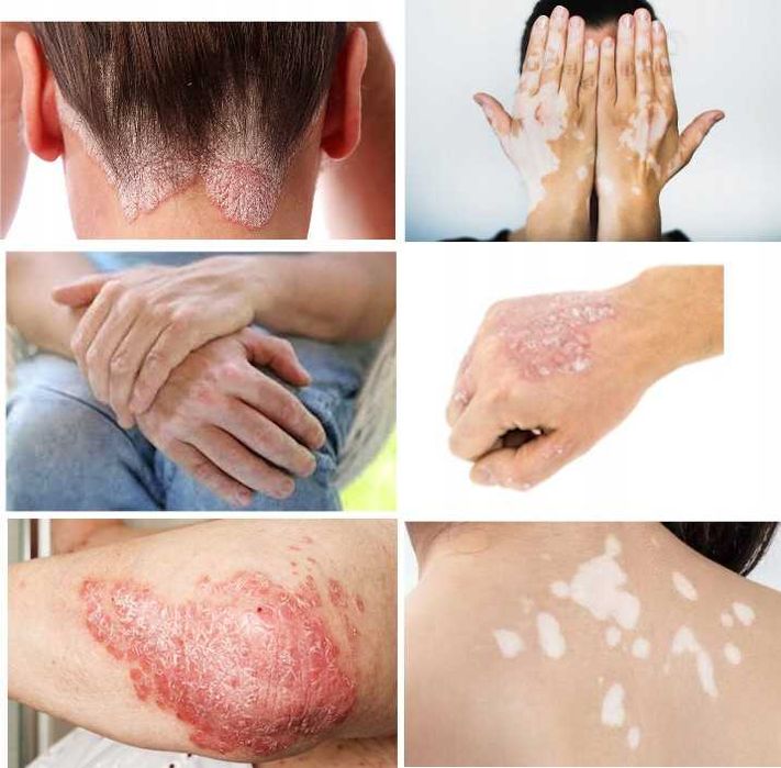 LAMPA medyczna PHILIPS PL-S 9W UVB 311nm +okulary łuszczyca azs