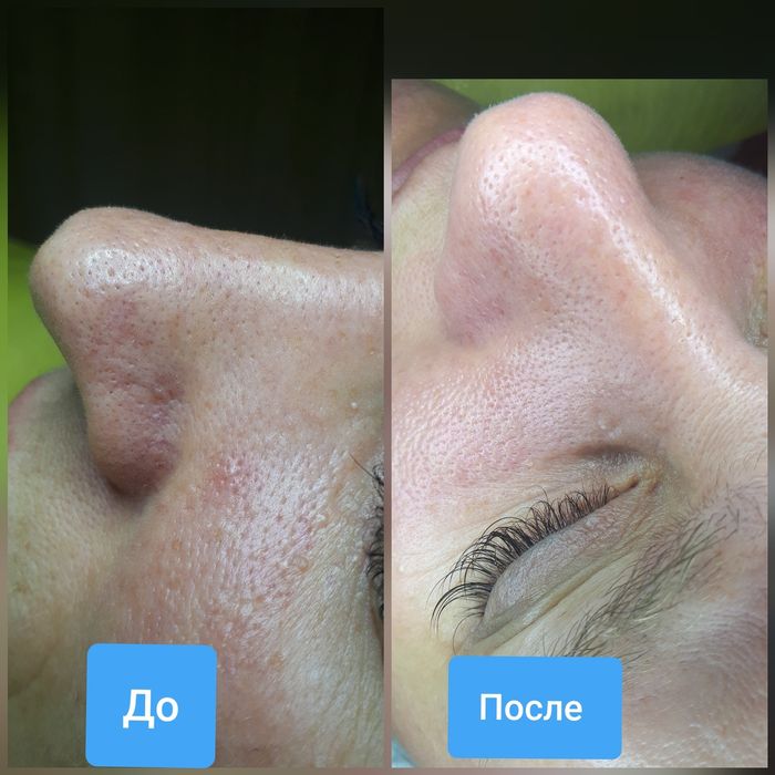 Косметолог.Увеличение губ  ,Чистка лица,Мезотерапия ,Плазмолифтинг.