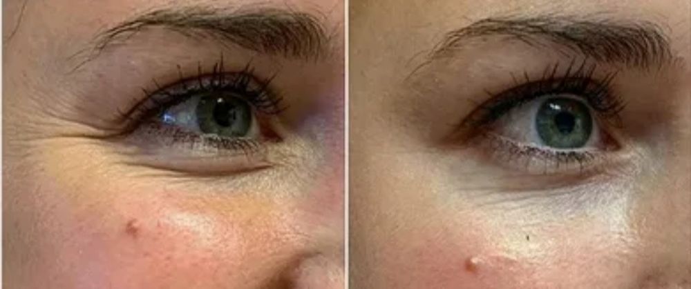 Ботулинотерапия! Гладкое личико! Ботокс!