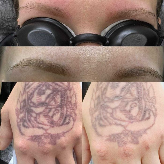 Видалення тату, татуювань і перманенту лазером. Київ, Лівий берег