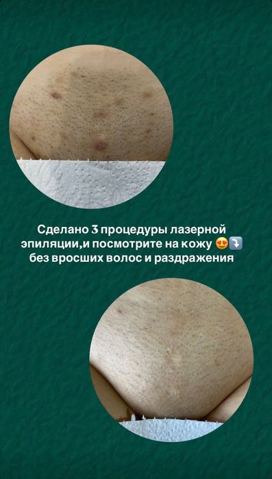 Лазерная эпиляция/Электроэпиляция/поселок Котовского