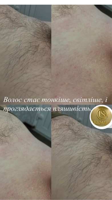 Чоловіча, жіноча депіляція, шугаринг, Миколаїв.