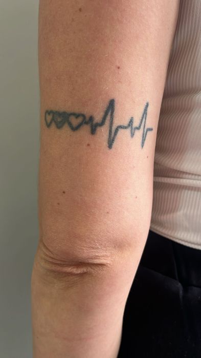 Modelos - Remoção de Tatuagem a Laser e Peeling de Hollywood
