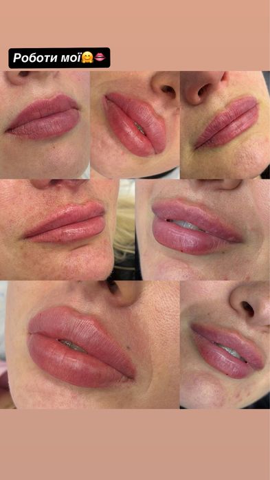 Контурна пластика губ