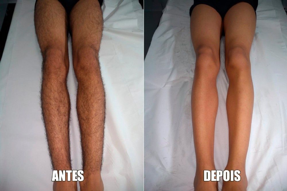 Depilação Masculina