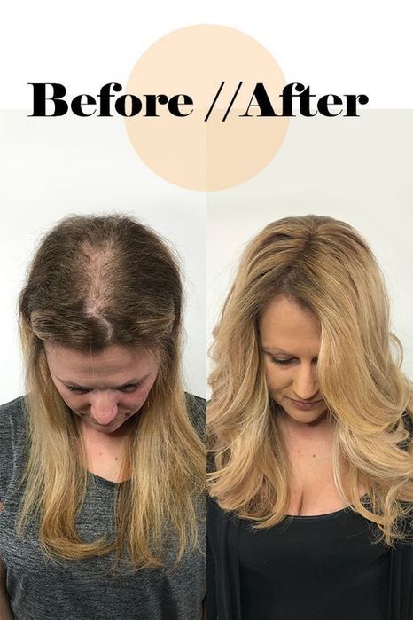 Curso Profissional de prótese capilar injetada em Alverca