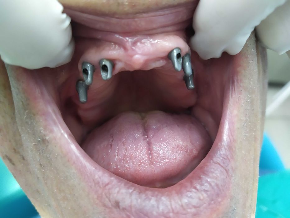 Стоматология. Протезирование .Имплантолгия