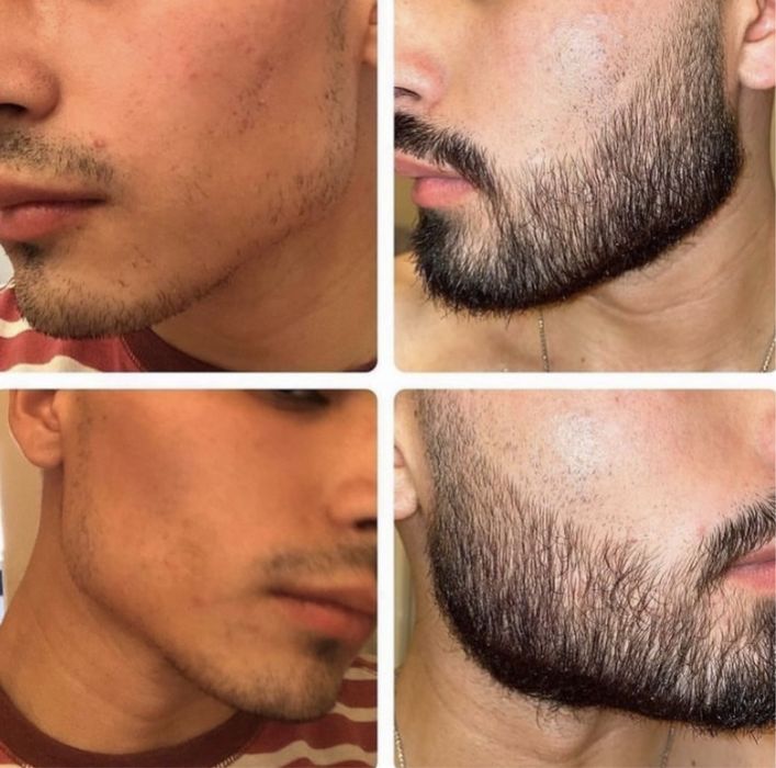 Minoxidil Original crescimento barba e cabelo
