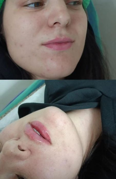 Увеличение губ ,индивидуальный подход. Сертифицированные препараты