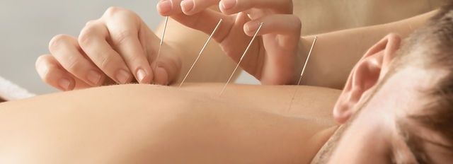 Akupunktura Zdrowotna - Suche Igłowanie / 100zł sesja akupunktury
