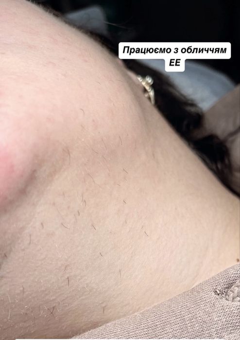 Електроепіляція / Електроепиляция