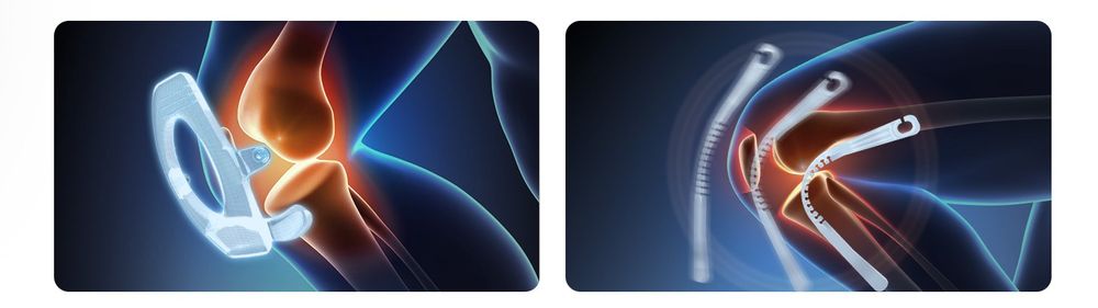 Ortezy kolana model NS70 Pro 3.0 Rozmiar XL