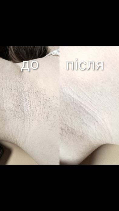 Воскова депіляція