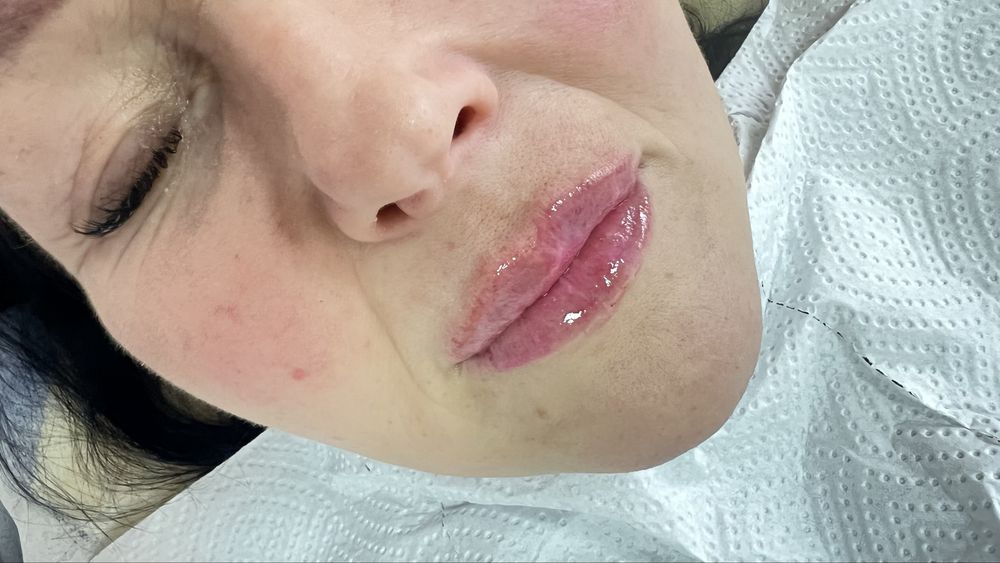 Лікар косметолог іньʼєкционіст АКЦИЯ ! Губы 1800/2000/3500/4400