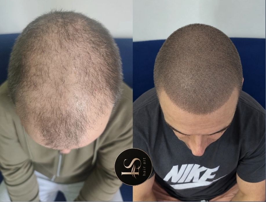 Preenchimento de barba e capilar
