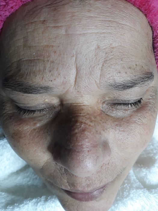 Limpeza De Pele