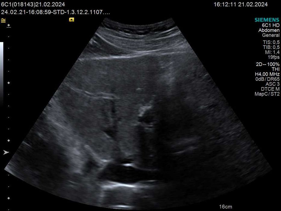 Конвексний датчик УЗД Siemens (Acuson) 6C1 HD