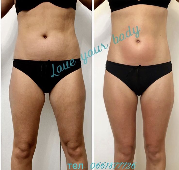 Антицеллюлитный массаж ЖК София